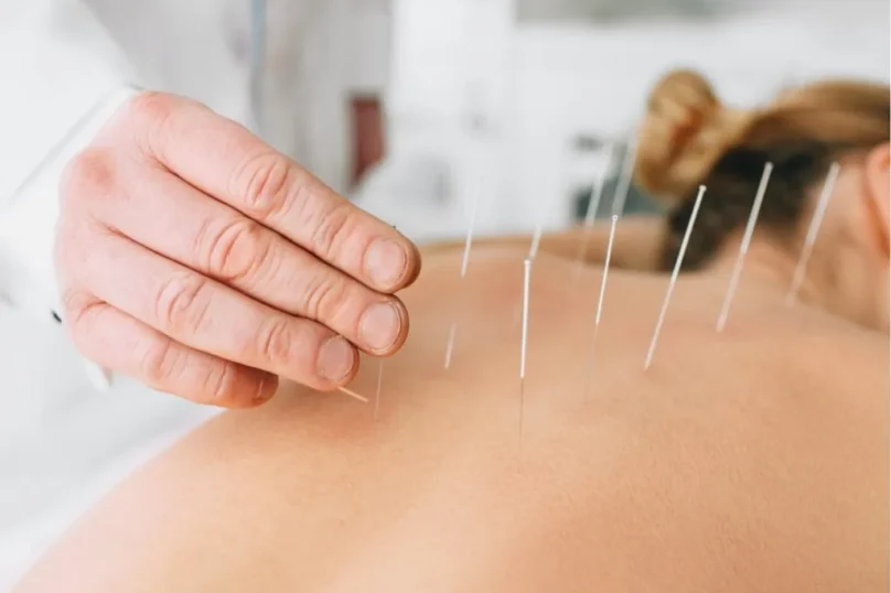 Dry Needling Therapy