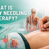 What is dry needling